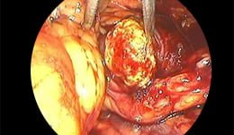 Obstrucción uretral